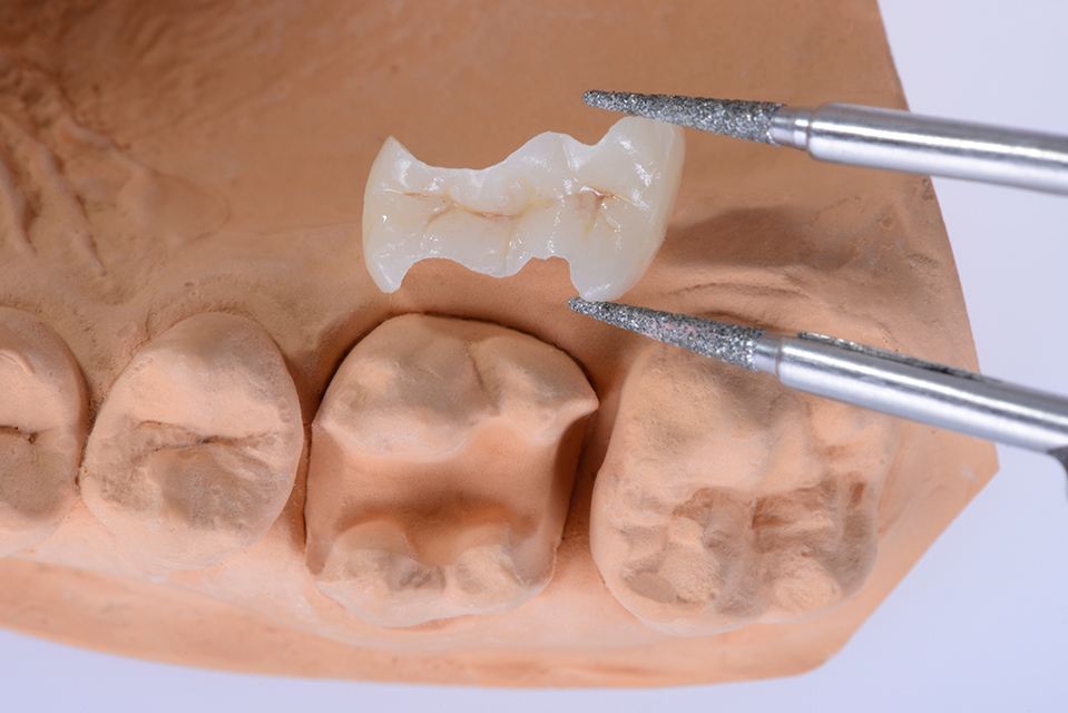 より自然なセラミックによる治療