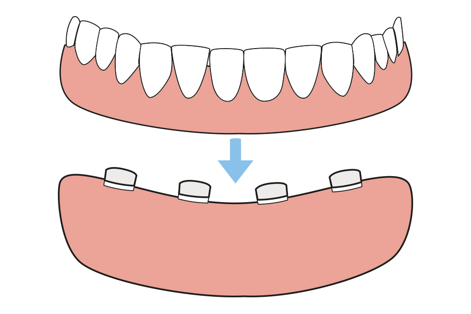 アタッチメント義歯（マグネットデンチャー）