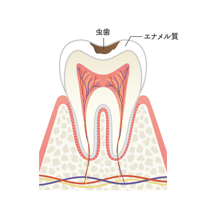 C1（エナメル質う蝕）