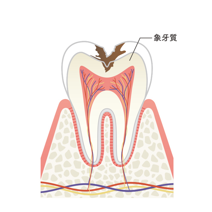 C2（象牙質う蝕）