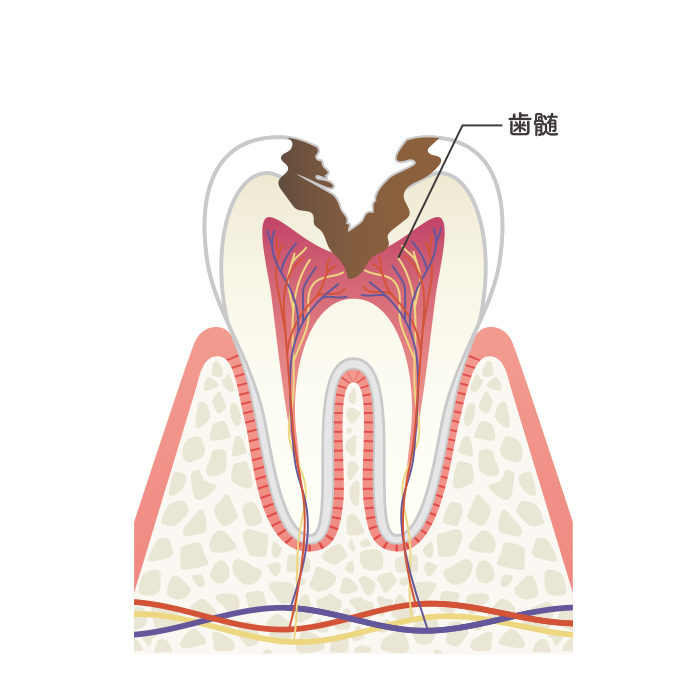 C3（神経まで到達したう蝕）