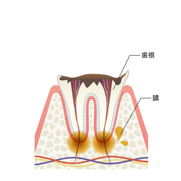 C4（残根状態）