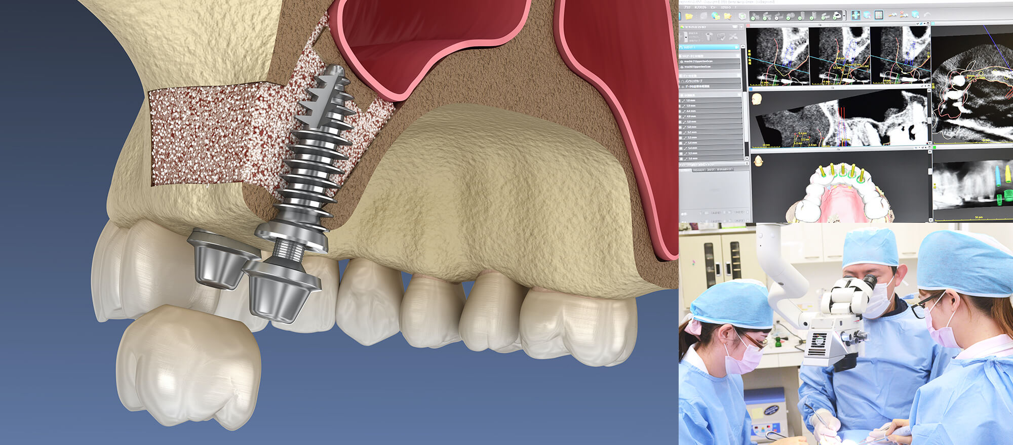 より精密な治療につながるインプラントマイクロサージェリー