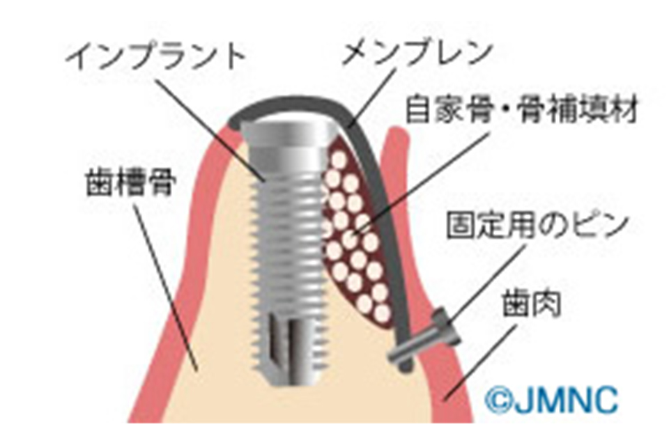 GBR法（骨誘導再生法）