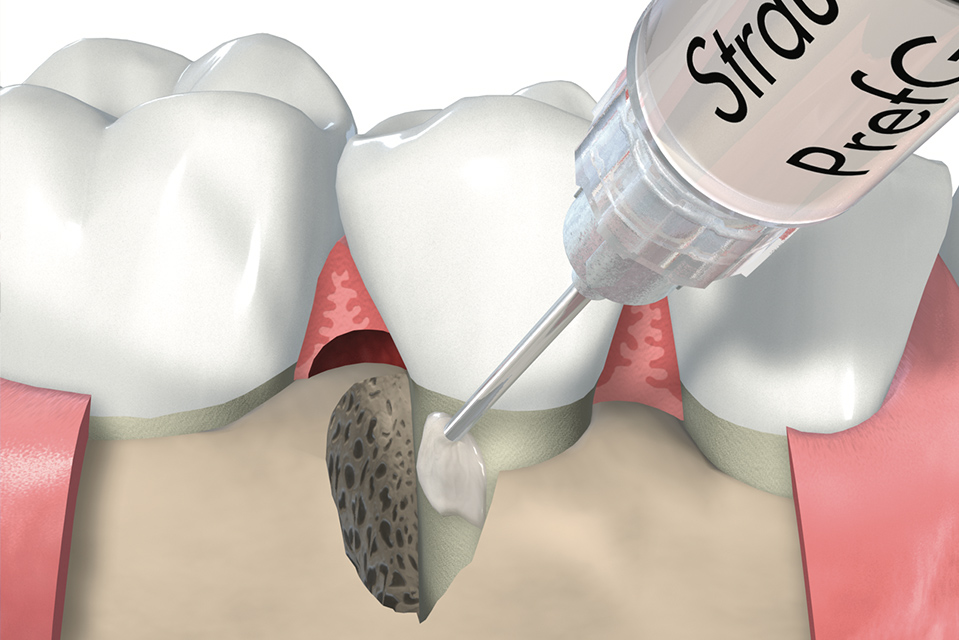 歯肉の再生療法とは