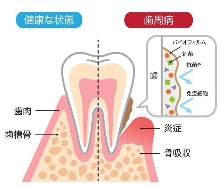 歯周病とは