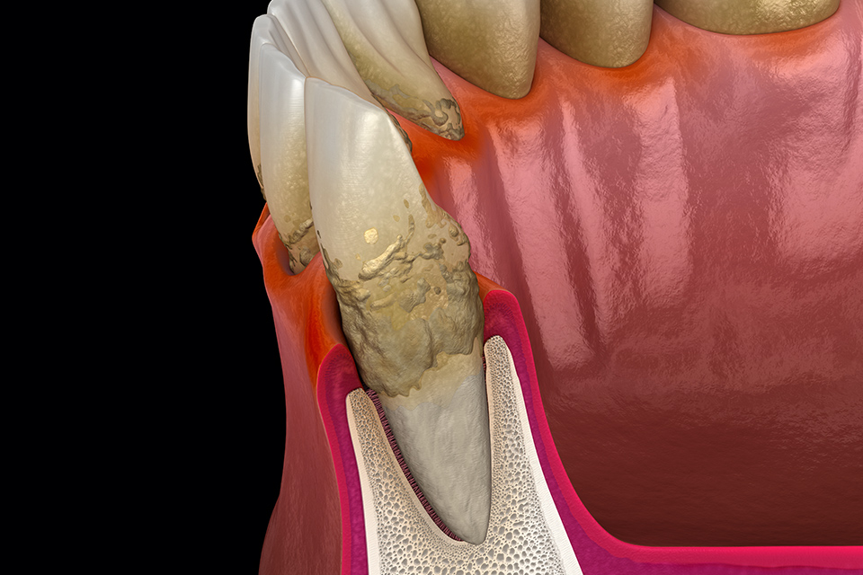 歯肉炎から一段階先の歯周炎