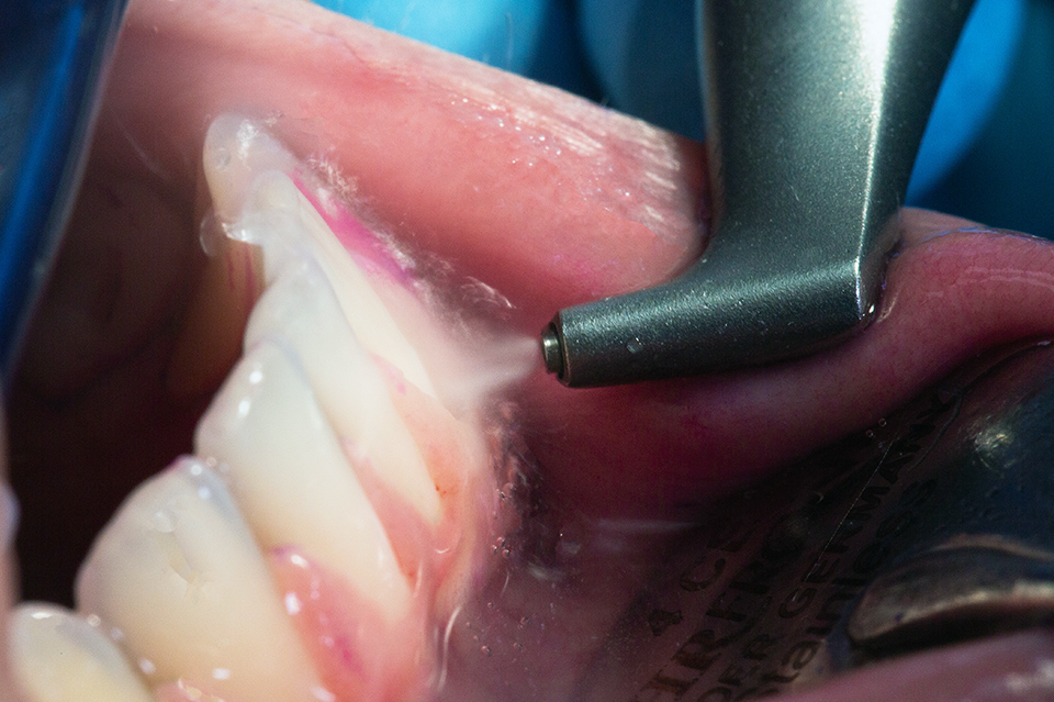 歯科用超音波歯面清掃器によるパウダートリートメントを使用したケア