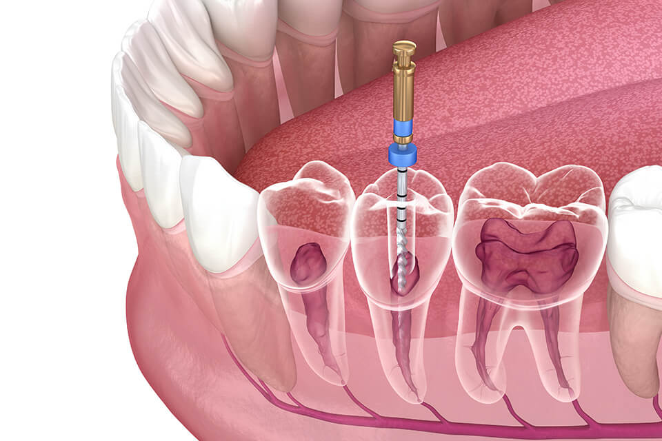 根管治療とは