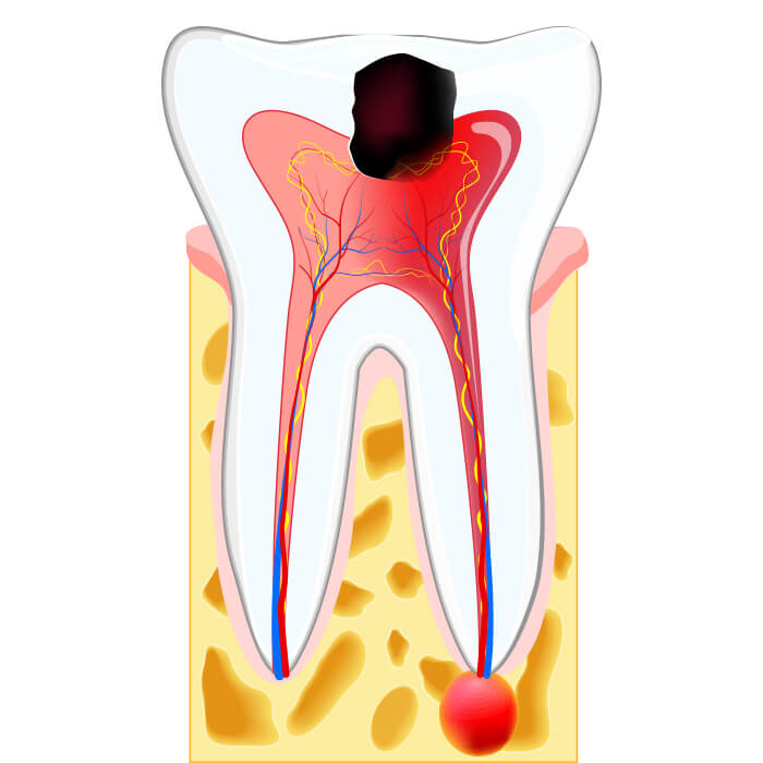 虫歯になった箇所から細菌がはいり、歯髄が汚染されてしまいます。